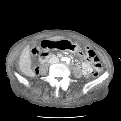Closed loop small bowel obstruction - adhesions and infarct (Radiopaedia 85125-100678 B 54).jpg