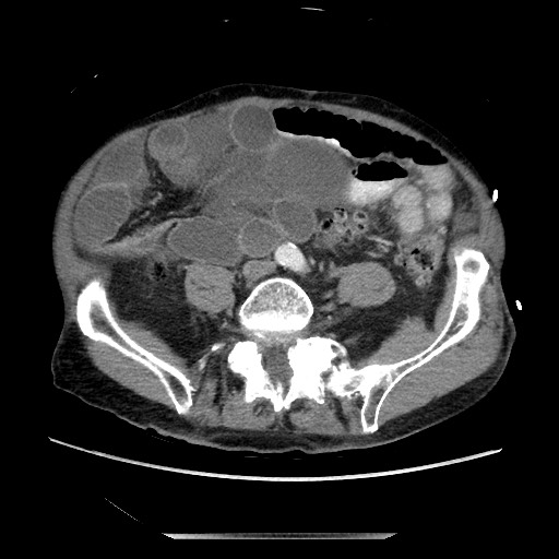 Closed loop small bowel obstruction - adhesive disease and hemorrhagic ischemia (Radiopaedia 86831-102990 A 125).jpg