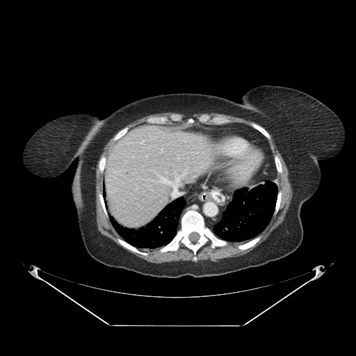 Closed loop small bowel obstruction - internal hernia (Radiopaedia 65402-74450 A 10).jpg