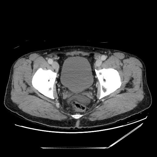 Closed loop small bowel obstruction - omental adhesion causing "internal hernia" (Radiopaedia 85129-100682 A 156).jpg