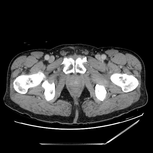 Closed loop small bowel obstruction - omental adhesion causing "internal hernia" (Radiopaedia 85129-100682 A 174).jpg