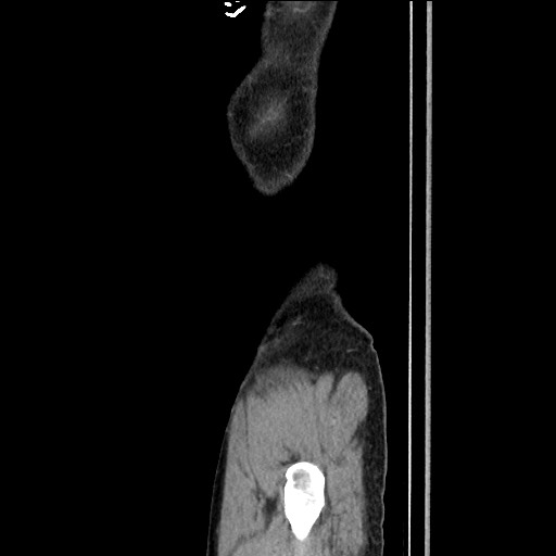 Closed loop small bowel obstruction - omental adhesion causing "internal hernia" (Radiopaedia 85129-100682 C 173).jpg