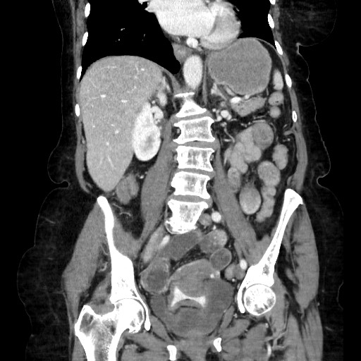 File:Closed loop small bowel obstruction due to adhesive band, with intramural hemorrhage and ischemia (Radiopaedia 83831-99017 C 71).jpg
