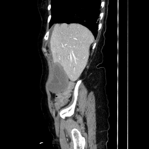 Closed loop small bowel obstruction due to adhesive band, with intramural hemorrhage and ischemia (Radiopaedia 83831-99017 D 55).jpg