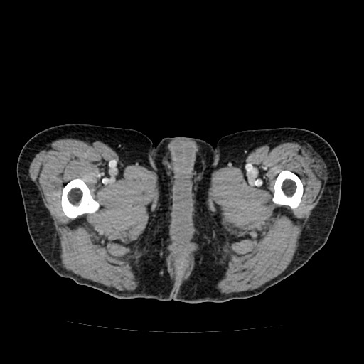 File:Closed loop small bowel obstruction due to adhesive band - U-shaped loop (Radiopaedia 83829-99012 A 82).jpg