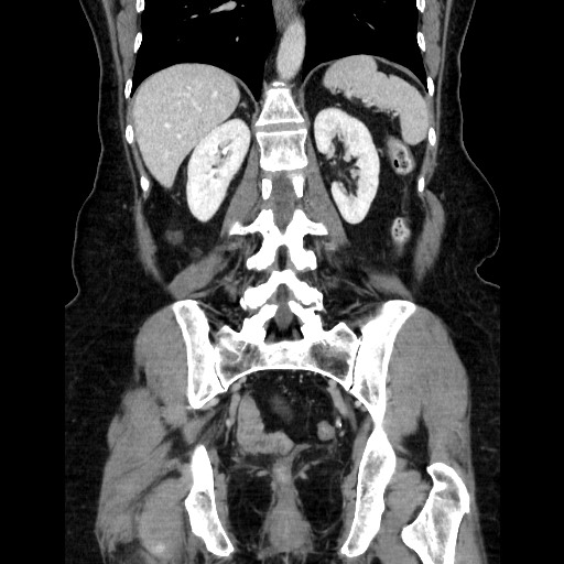 Closed loop small bowel obstruction due to adhesive bands - early and late images (Radiopaedia 83830-99015 B 86).jpg