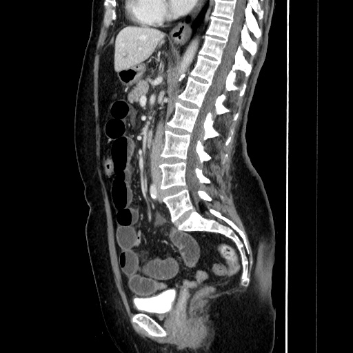 Closed loop small bowel obstruction due to adhesive bands - early and late images (Radiopaedia 83830-99015 C 90).jpg