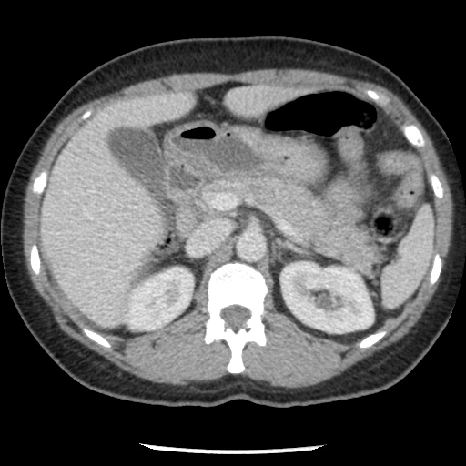 Closed loop small bowel obstruction due to trans-omental herniation (Radiopaedia 35593-37109 A 30).jpg