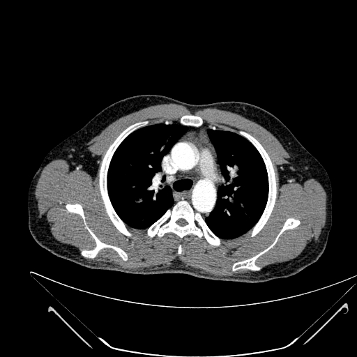File:Coarctation of the aorta (Radiopaedia 49784-55050 B 68).jpg