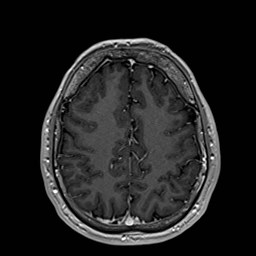 Cochlear incomplete partition type III associated with hypothalamic hamartoma (Radiopaedia 88756-105498 Axial T1 C+ 142).jpg