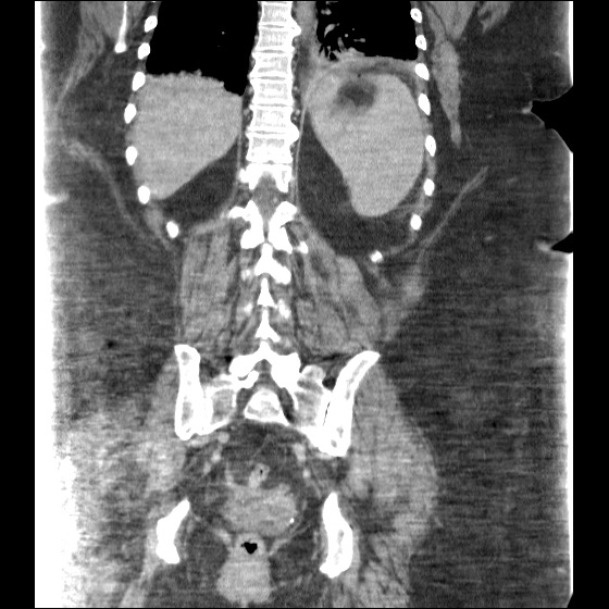 File:Collection due to leak after sleeve gastrectomy (Radiopaedia 55504-61972 B 35).jpg