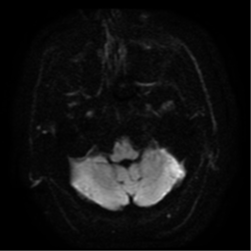 File:Colloid cyst (large) (Radiopaedia 34415-35729 Axial DWI 4).png