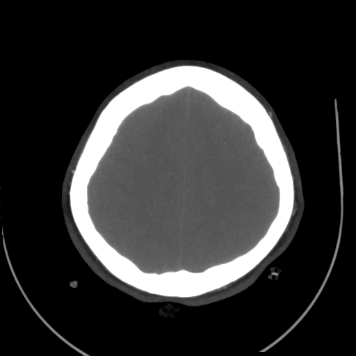 File:Colloid cyst (resulting in death) (Radiopaedia 33423-34499 A 46).png