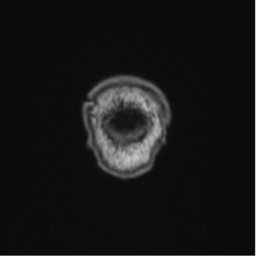 Colloid cyst of the third ventricle (Radiopaedia 86571-102662 Coronal T1 2).png