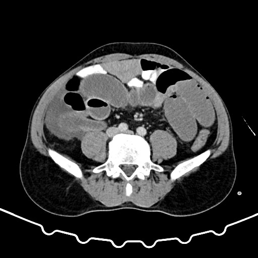 Colocolic intussusception due to large lipoma (Radiopaedia 68773-78482 A 122).jpg