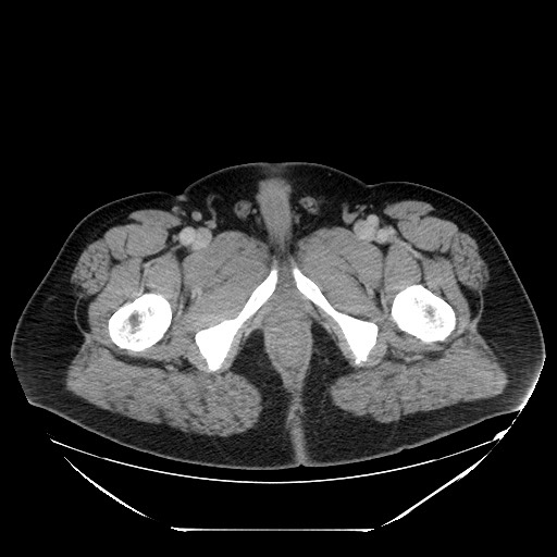 File:Colocolic intussusception due to lipoma (Radiopaedia 73712-84508 Axial 123).jpg