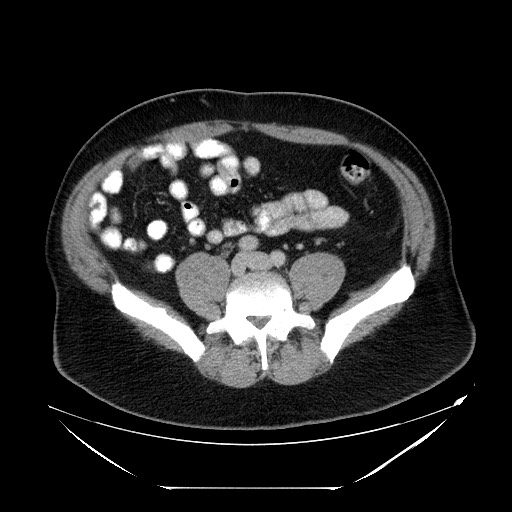 File:Colocolic intussusception due to lipoma (Radiopaedia 73712-84508 Axial 78).jpg