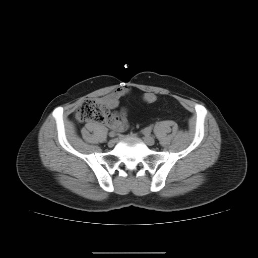 File:Colocutaneous fistula in Crohn's disease (Radiopaedia 29586-30093 Axial non-contrast 27).jpg