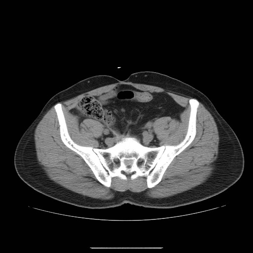 File:Colocutaneous fistula in Crohn's disease (Radiopaedia 29586-30093 Axial non-contrast 29).jpg