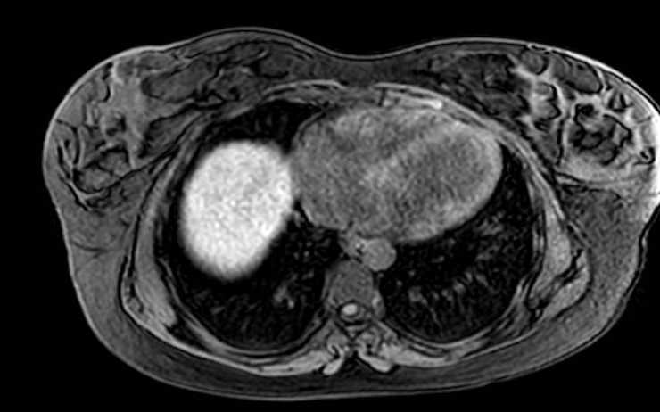 Colon adenocarcinoma with Krukenberg tumors, advanced pregnancy (Radiopaedia 67279-76645 A 79).jpg