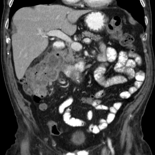 File:Colon cancer with duodenal invasion (Radiopaedia 16278-15958 B 25).jpg