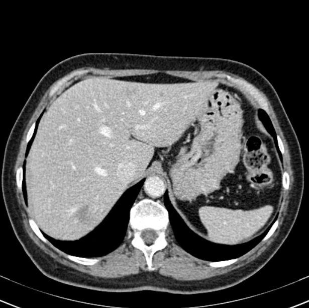 Colon carcinoma with hepatic metastases (Radiopaedia 29477-29961 A 21).jpg