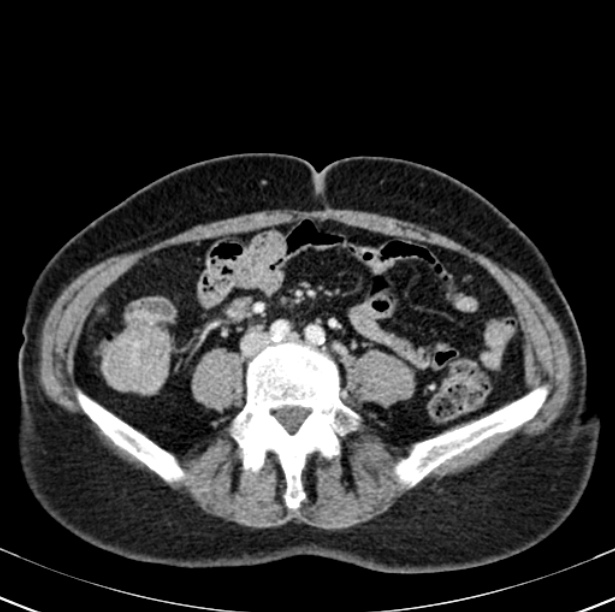 Colon carcinoma with hepatic metastases (Radiopaedia 29477-29961 A 71).jpg