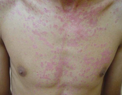 File:Epidermodysplasia verruciformis in a young man with HIV (trunk).png