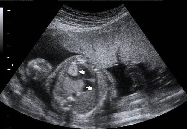 File:Fetal cardiac rhabdomyoma (Radiopaedia 17302).jpg