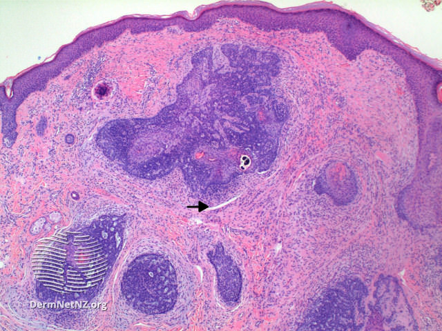 File:Figure 2 (DermNet NZ pathology-e-trichoepithelioma-with-arrow).jpg