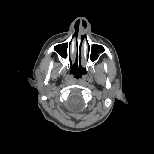 Nasal pyogenic granuloma (lobular capillary hemangioma) (Radiopaedia 85536-101244 Axial non-contrast 21).jpg