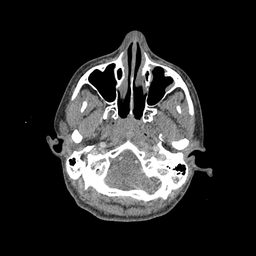 Nasal pyogenic granuloma (lobular capillary hemangioma) (Radiopaedia 85536-101244 C 57).jpg