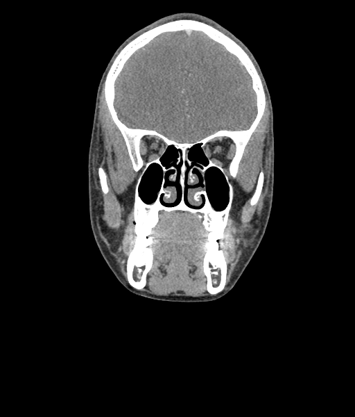 Nasal pyogenic granuloma (lobular capillary hemangioma) (Radiopaedia 85536-101244 D 54).jpg