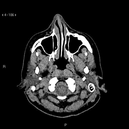 Nasolabial cyst (Radiopaedia 75125-86194 Axial non-contrast 68).jpg