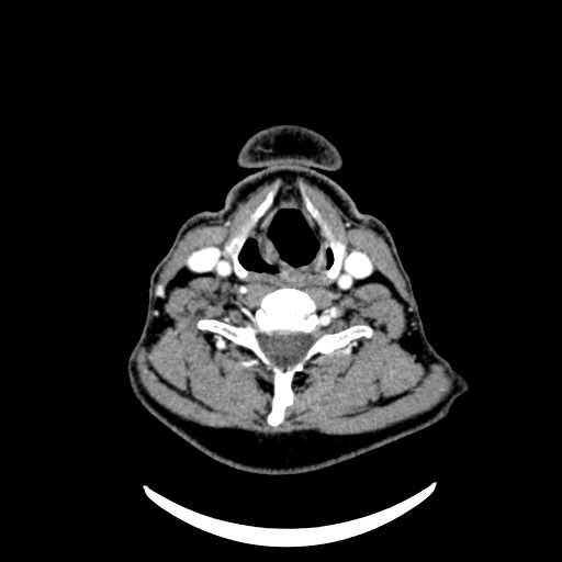 File:Nasopharyngeal carcinoma - infiltrating the clivus (Radiopaedia 62583-70875 Axial Post contrast 52).jpg