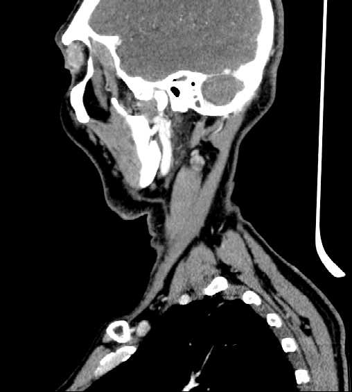 File:Nasopharyngeal carcinoma - infiltrating the clivus (Radiopaedia 62583-70875 C 43).jpg