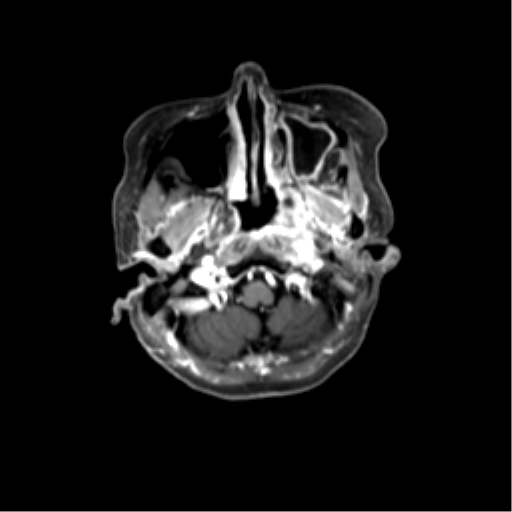 File:Nasopharyngeal carcinoma with cerebral abscess (Radiopaedia 43018-46274 Axial T1 C+ fat sat 10).png