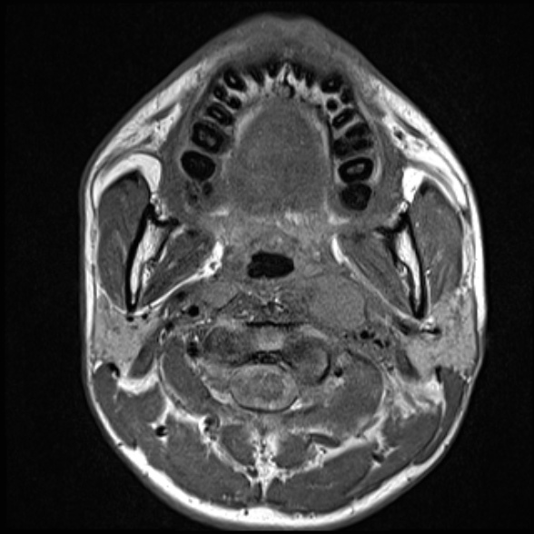 Nasopharyngeal carcinoma with skull base invasion (Radiopaedia 53415-59485 Axial T1 36).jpg