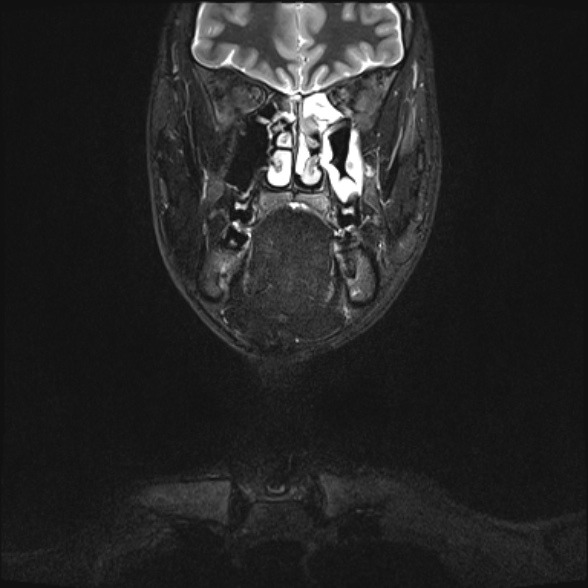 Nasopharyngeal carcinoma with skull base invasion (Radiopaedia 53415-59485 Coronal T2 fat sat 29).jpg