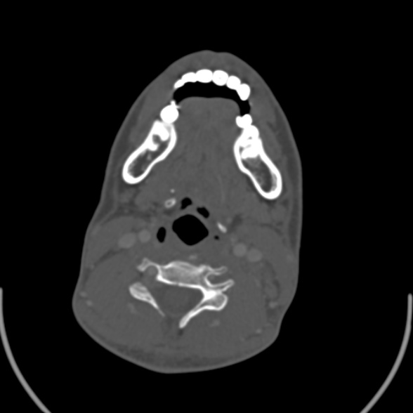 Nasopharyngeal carcinoma with skull base invasion (Radiopaedia 53415-59705 Axial bone window 123).jpg