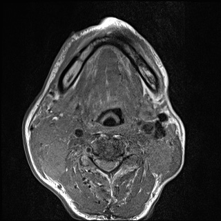 Nasopharyngeal carcinoma with skull base invasion (Radiopaedia 59258-66600 B 42).jpg