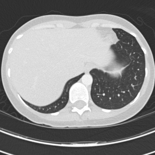 Necrobiotic pulmonary nodules - Crohn disease (Radiopaedia 20723-20631 Axial lung window 122).jpg