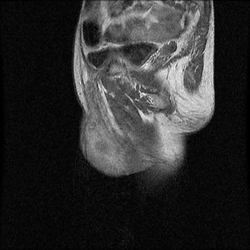 File:Necrotizing epididymo-orchitis with intra-testicular abscess (Radiopaedia 29397-29860 Sagittal T1 C+ 15).jpg