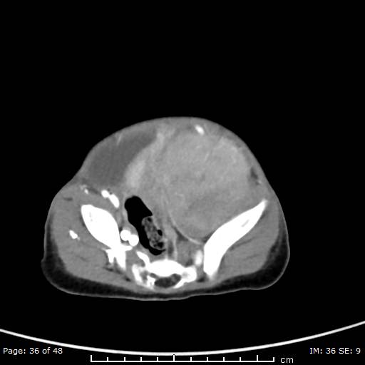File:Neuroblastoma (Radiopaedia 41472-44355 A 36).jpg