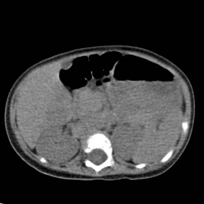 Neuroblastoma with skull metastases (Radiopaedia 30326-30960 Axial non-contrast 23).jpg