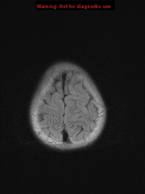 File:Neurofibromatosis type 1 with optic nerve glioma (Radiopaedia 16288-15965 Axial FLAIR 3).jpg