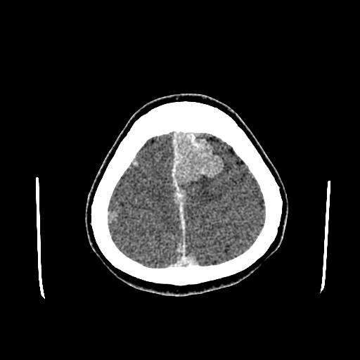 File:Neurofibromatosis type 2 (Radiopaedia 25389-25637 Axial C+ 87).jpg