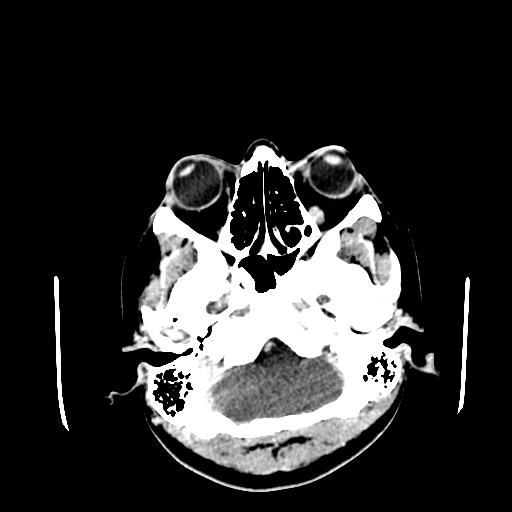 File:Neurofibromatosis type 2 (Radiopaedia 25389-25637 Axial C+ 9).jpg