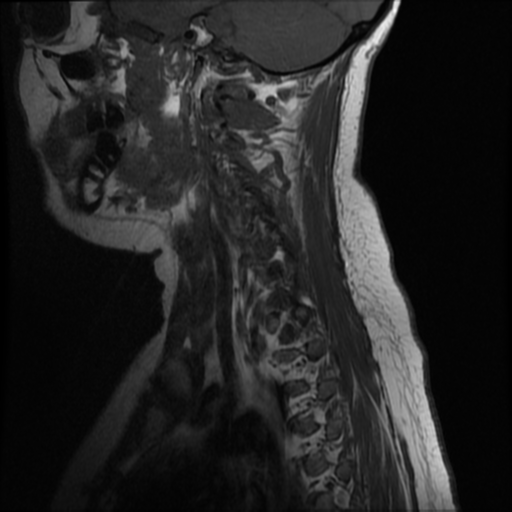 File:Neurofibromatosis type 2 (Radiopaedia 45229-49252 Sagittal T1 2).png