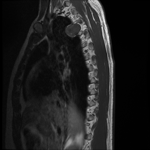 File:Neurofibromatosis type 2 (spinal manifestations) (Radiopaedia 53943-60070 D 14).png